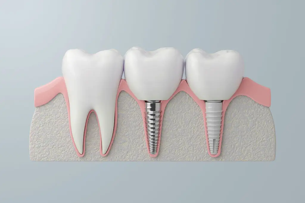 How Long Do Dental Implants Last? A Guide for Naples Patients